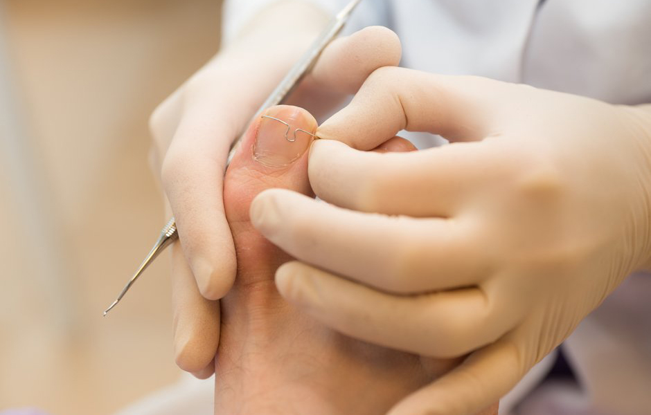 Podotherapie voor ingegroeide nagels